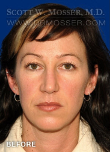 Upper Blepharoplasty Patient 81608 Before Photo # 1