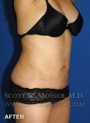 Liposuction - Abdomen & Flanks Patient 30590 After Photo # 4