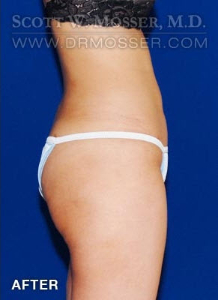 Liposuction - Abdomen & Flanks Patient 82898 After Photo # 6