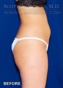Liposuction - Abdomen & Flanks Patient 82898 Before Photo Thumbnail # 5