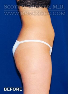 Liposuction - Abdomen & Flanks Patient 82898 Before Photo # 5