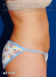 Liposuction - Abdomen & Flanks Patient 39576 After Photo # 4