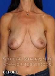 Breast Lift With Implants Patient 19074 Before Photo # 1