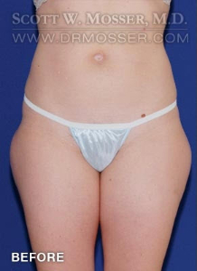 Liposuction - Thighs Patient 42034 Before Photo # 1