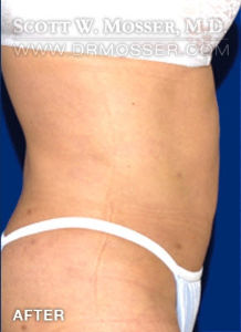 Liposuction - Abdomen & Flanks Patient 68884 After Photo # 6