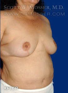 Breast Reduction Patient 54296 After Photo # 4