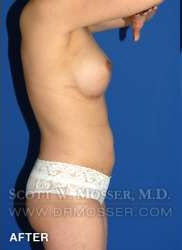 Liposuction - Abdomen & Flanks Patient 98943 After Photo # 8
