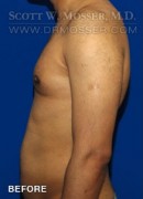 Liposuction - Chest Patient 51091 Before Photo Thumbnail # 3