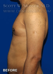 Liposuction - Chest Patient 51091 Before Photo # 3