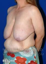 Breast Reduction Patient 97519 Before Photo # 3