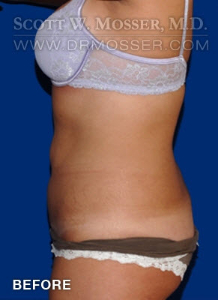 Liposuction - Abdomen & Flanks Patient 79590 Before Photo # 5
