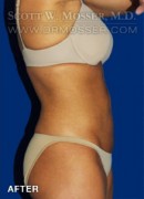 Liposuction - Abdomen & Flanks Patient 83778 After Photo Thumbnail # 6