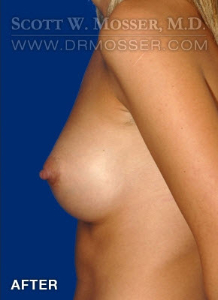 Breast Augmentation Patient 51986 After Photo # 6