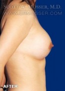 Breast Augmentation Patient 66017 After Photo Thumbnail # 6
