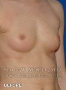 Nipple Inversion Correction Patient