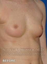 Nipple Inversion Correction Patient 70533 Before Photo # 1