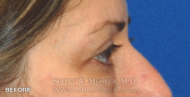 Lower Blepharoplasty Patient 88372 Before Photo # 5