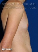 Breast Augmentation Patient 21498 Before Photo Thumbnail # 5