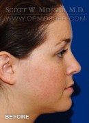 Liposuction - Face Patient 40198 Before Photo Thumbnail # 5