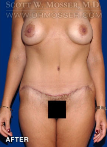 Abdominoplasty Patient 54737 After Photo # 2