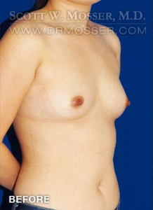 Breast Augmentation Patient 66017 Before Photo # 3