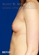 Breast Augmentation Patient 41756 Before Photo Thumbnail # 5
