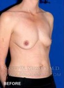 Breast Asymmetry Correction Patient 37996 Before Photo Thumbnail # 9