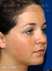Liposuction - Face Patient 40198 Before Photo # 3