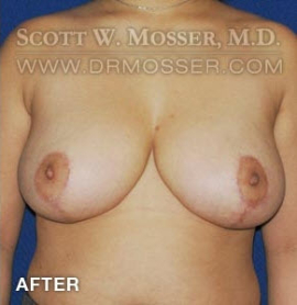 Breast Reduction Patient 54903 After Photo # 2