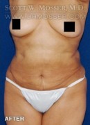 Liposuction - Abdomen & Flanks Patient 51266 After Photo Thumbnail # 2