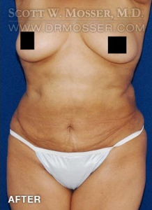 Liposuction - Abdomen & Flanks Patient 51266 After Photo # 2