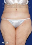 Abdominoplasty Patient 61872 After Photo Thumbnail # 2