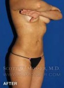 Liposuction - Abdomen & Flanks Patient 33709 After Photo Thumbnail # 4