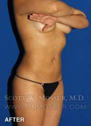 Liposuction - Abdomen & Flanks Patient 33709 After Photo # 4