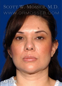 Liposuction - Face Patient 78389 After Photo # 2
