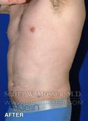 Liposuction - Abdomen & Flanks Patient 64992 After Photo # 6