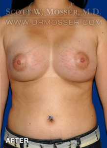 Breast Augmentation Patient 59926 After Photo # 2