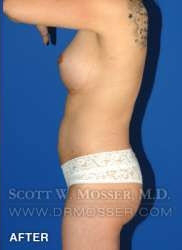 Liposuction - Thighs Patient 89876 After Photo # 2