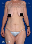 Lower Body Lift Patient 68424 Before Photo Thumbnail # 1