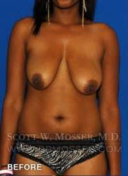 Breast Lift Without Implants Patient 55667 Before Photo # 1