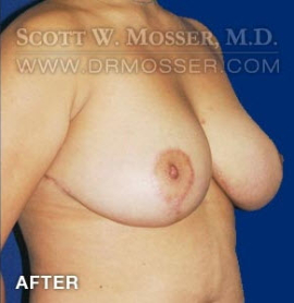 Breast Reduction Patient 54903 After Photo # 6