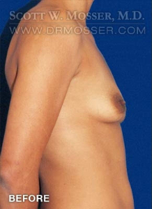 Breast Augmentation Patient 83067 Before Photo # 5