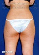 Liposuction - Abdomen & Flanks Patient 82898 Before Photo Thumbnail # 3