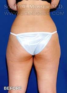 Liposuction - Abdomen & Flanks Patient 82898 Before Photo # 3