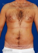 Liposuction - Chest Patient 51212 Before Photo Thumbnail # 1