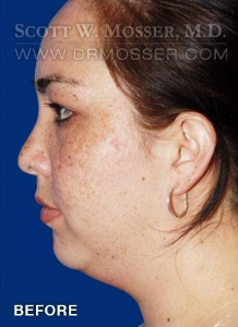 Chin Implant Patient 69285 Before Photo # 5