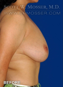 Breast Reduction Patient 13262 Before Photo # 5