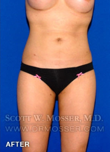 Liposuction - Thighs Patient 46631 After Photo # 2