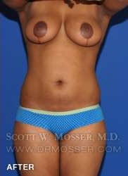 Liposuction - Abdomen & Flanks Patient 11942 After Photo # 2