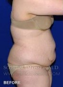 Liposuction - Abdomen & Flanks Patient 26351 Before Photo Thumbnail # 5
